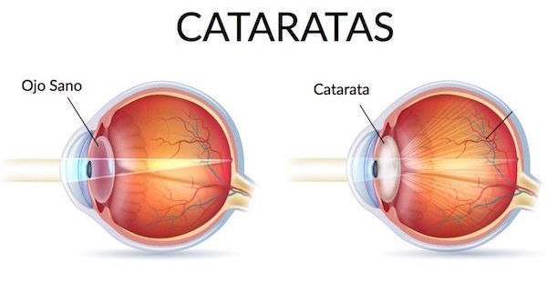 Clinica Oftalmologica en La Roma Norte Oftalmologos en Mexico Especialistas en Cirugia de Cataratas v002 compressor