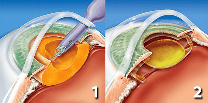 Clinica Oftalmologica en La Roma Norte Oftalmologos en Mexico Especialistas en Facoemulsificacion v002 compressor