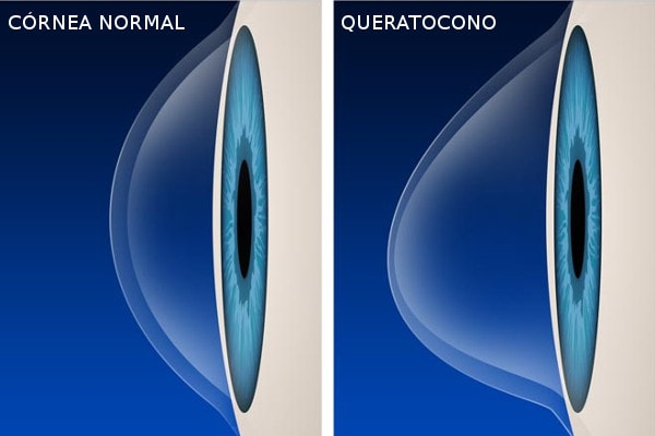 queratocono-1