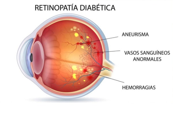 retinopatia-diabetica-1