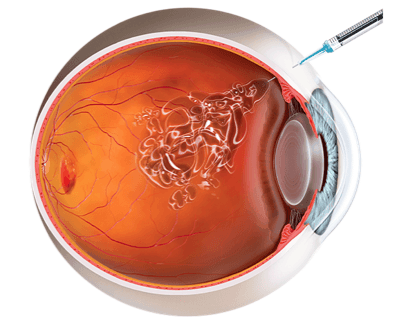 Clinica Oftalmologica Visioni Medicos Oftalmologos en Mexico Especialistas en Inyecciones intravitreas v003 compressor